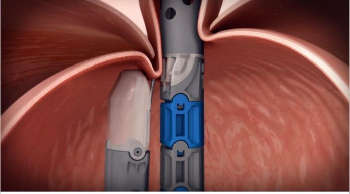 Novo tratamento para refluxo chega ao Brasil Dispositivo médico já é amplamente usado em tratamento de refluxo nos EUA e na Europa. Foto: Divulgação