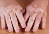 Cerca de 1 milhão de pessoas no Brasil têm Vitiligo 1% da população mundial sofre com a doença. Foto: Divulgação