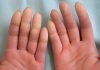Esclerose Sistêmica, quando as pontas dos dedos mudam de cor
