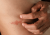 Herpes Zoster: Entendendo o “Cobreiro”