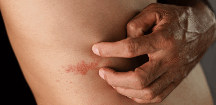 Herpes Zoster