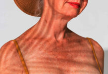 Manchas brancas na pele podem estar ligadas ao excesso de sol ao longo da vida