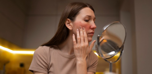 Mês de abril tem foco na rosácea, que pede abordagem personalizada para evitar impactos na qualidade de vida